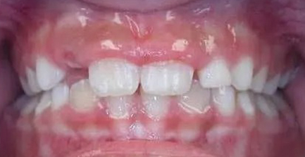 Close-up of aligned white teeth and healthy pink gums in dental setting