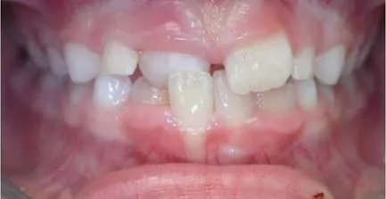 Close-up of child's teeth showing gap between front teeth before orthodontic treatment.