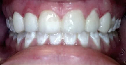 Close-up view of healthy white teeth in proper alignment after orthodontic treatment.