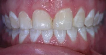 Close-up view of aligned upper and lower teeth showing healthy dental results from orthodontic treatment.
