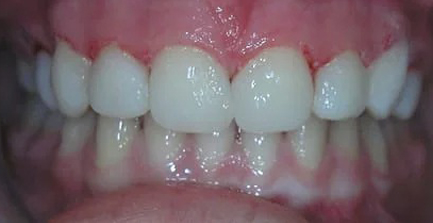 Close-up view of upper and lower front teeth showing dental alignment and whiteness during orthodontic examination.