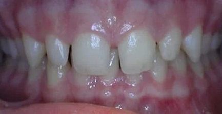 Close-up of upper front teeth showing gaps between incisors and gum inflammation in dental setting.