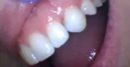 Close-up view of white dental crowns or veneers on upper teeth inside mouth during dental examination.