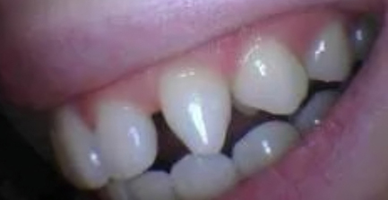 Close-up of teeth showing dental crowding and misalignment requiring orthodontic treatment.