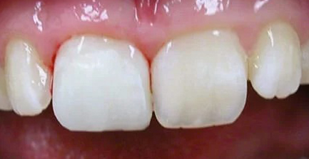 Close-up of upper front teeth showing white dental crowns and natural tooth structure in clinical setting.