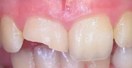 Close-up of teeth showing dental work or orthodontic treatment progress with pink gum tissue visible.