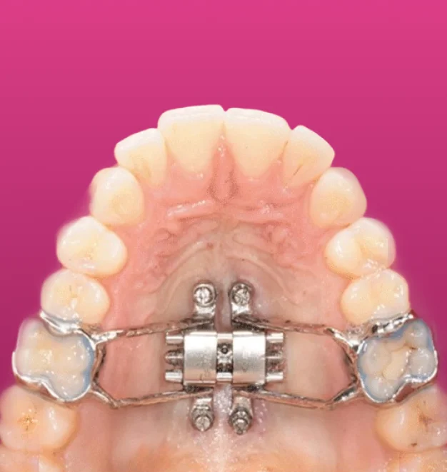 MARPE palate expander fitted in a patient’s upper mouth, with a central screw and mini-screws in the palate, on a magenta background
