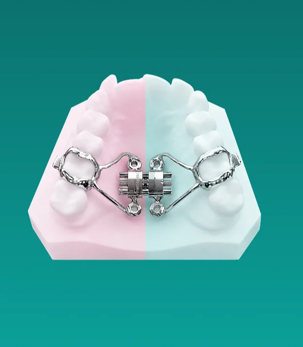 MARPE dental expansion appliance displayed on a bisected teeth model showing pink and white halves.